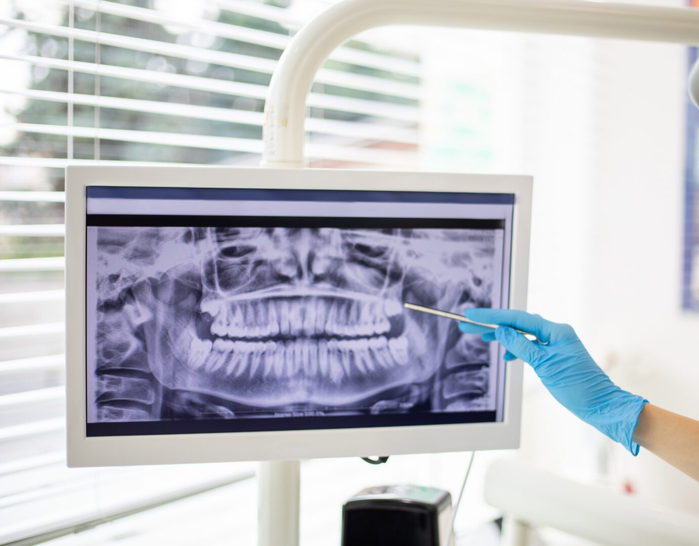 Dental X-ray on screen with gloved hand.