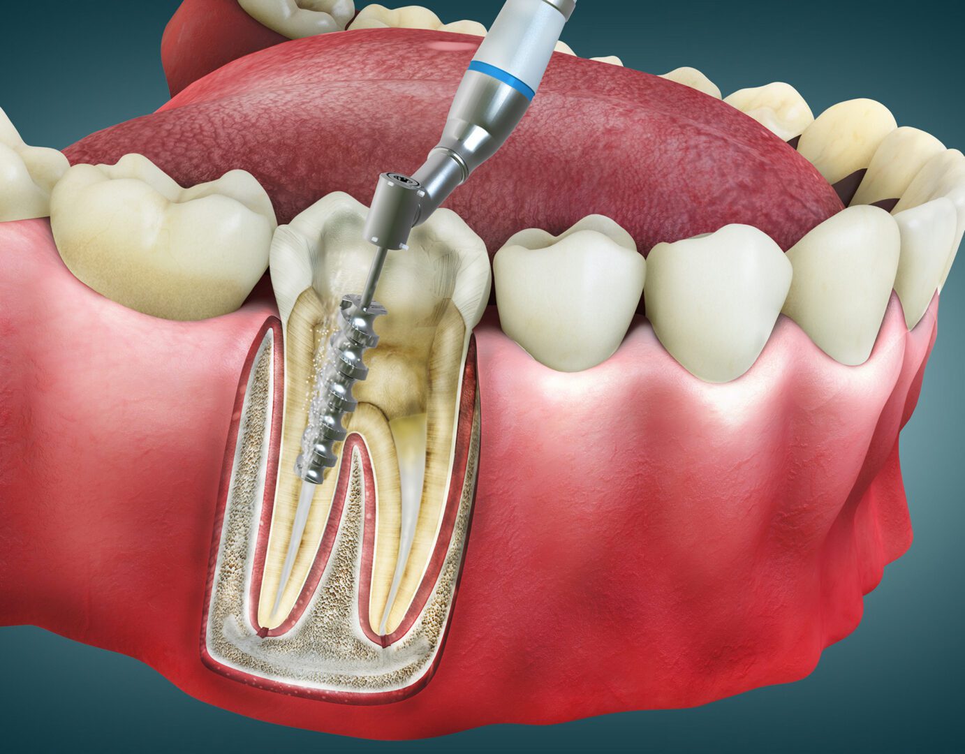 Endodontic treatment on molar tooth diagram