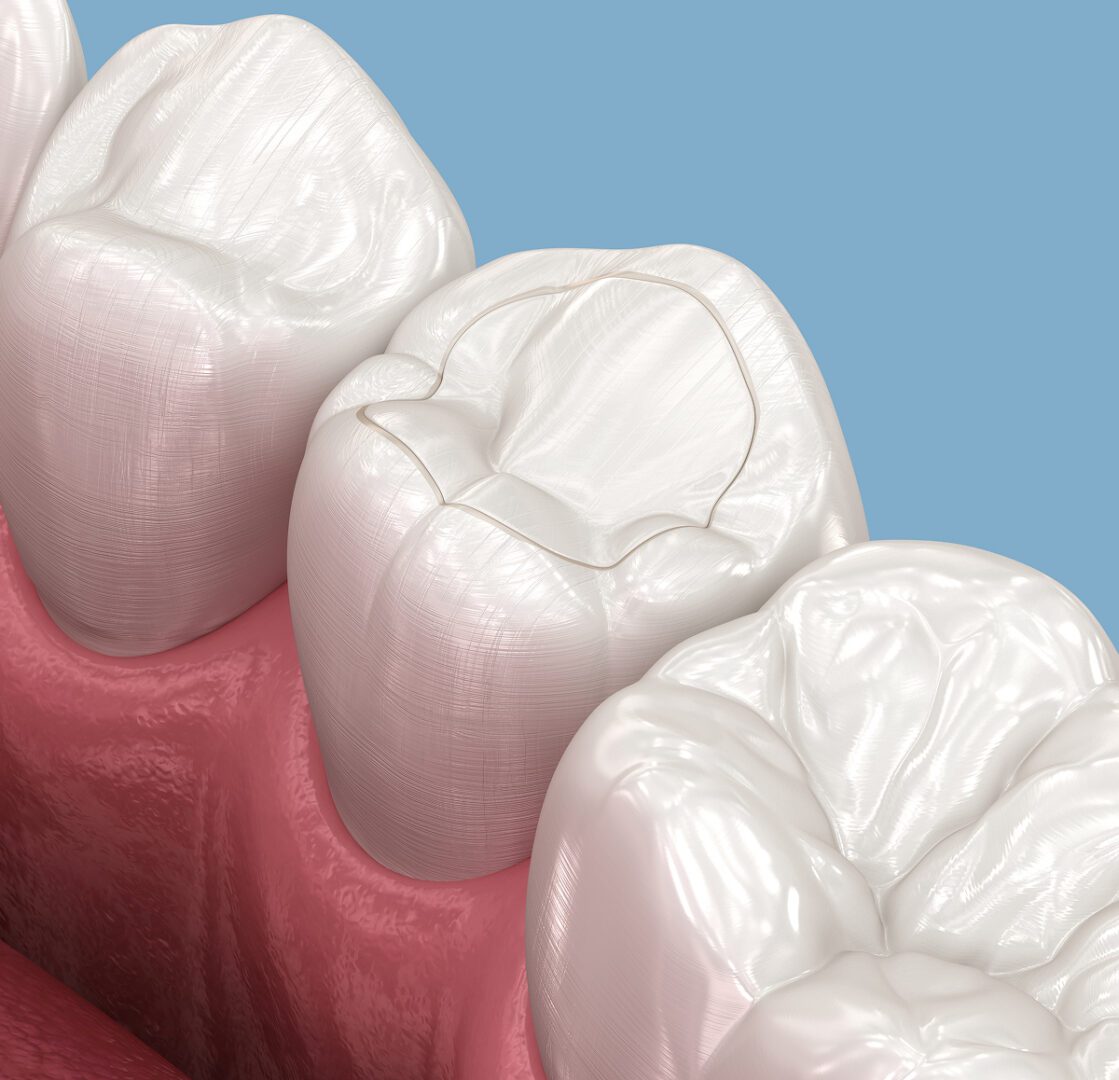 Tooth with dental sealant illustration